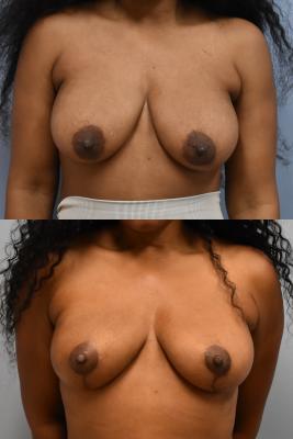 Oncoplastic Reduction