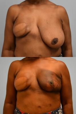 Oncoplastic Reduction