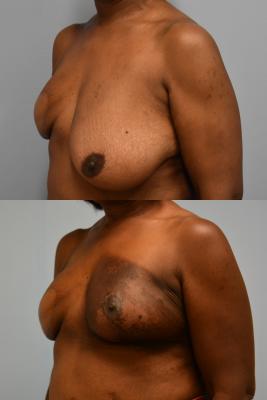 Oncoplastic Reduction