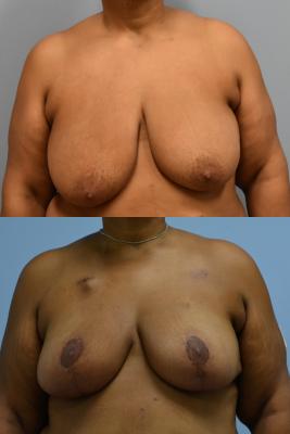 Oncoplastic Reduction