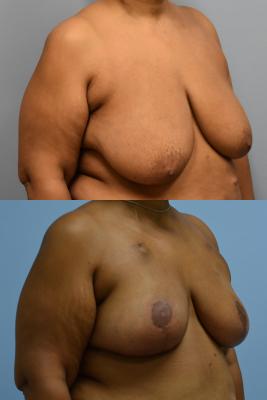 Oncoplastic Reduction