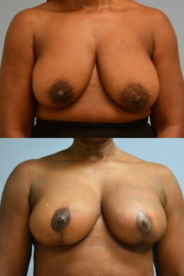 Oncoplastic Reduction