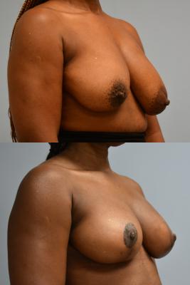 Oncoplastic Reduction