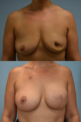 Breast Reconstruction