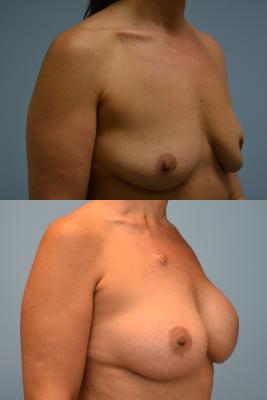 Breast Reconstruction