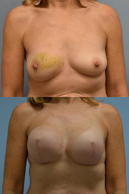 Breast Reconstruction