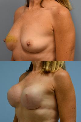 Breast Reconstruction