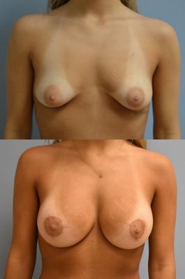 Breast Reconstruction