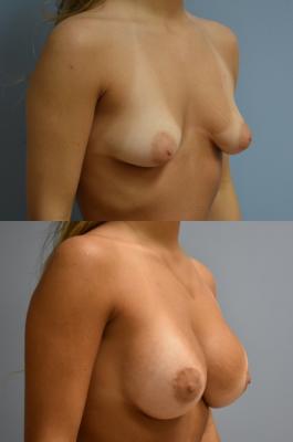 Breast Reconstruction