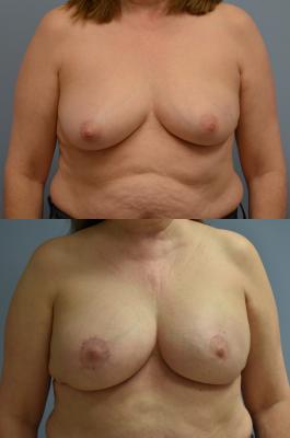 Breast Reconstruction