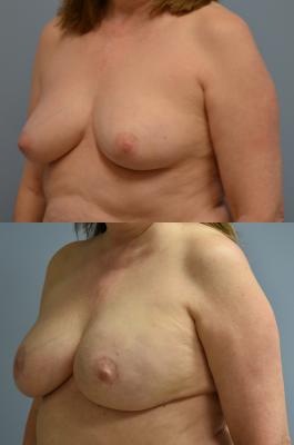 Breast Reconstruction