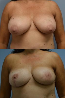 Breast Reconstruction