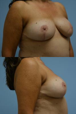Breast Reconstruction