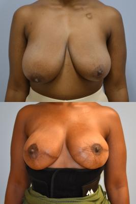 Breast Reconstruction with Tissue Expander