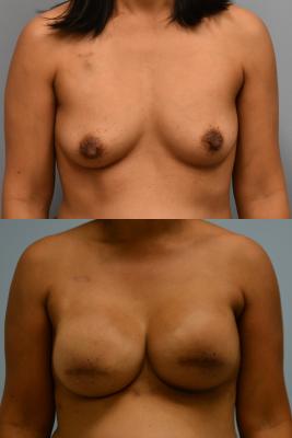 Breast Reconstruction