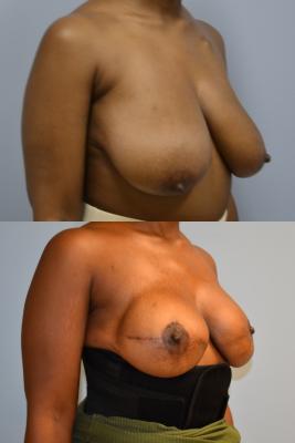 Breast reconstruction with Tissue Expander