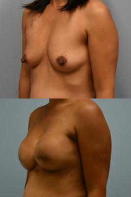 Breast Reconstruction
