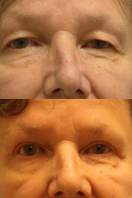 Upper Blepharoplasty and Brow Lift 