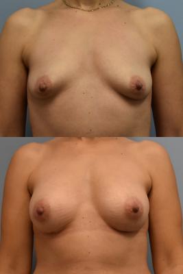 BREAST AUGMENTATION