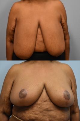 BREAST REDUCTION