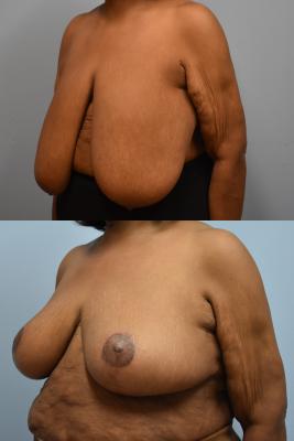 BREAST REDUCTION