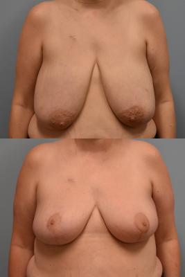 ONCOPLASTIC BREAST REDUCTION