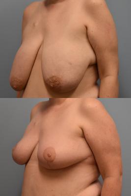 ONCOPLASTIC BREAST REDUCTION