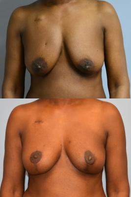 ONCOPLASTIC BREAST REDUCTION