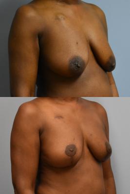 ONCOPLASTIC BREAST REDUCTION