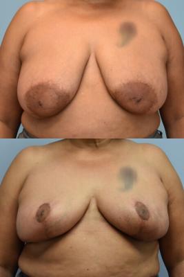 ONCOPLASTIC BREAST REDUCTION