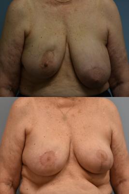 ONCOPLASTIC BREAST REDUCTION