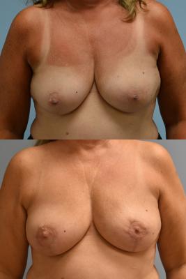 ONCOPLASTIC BREAST REDUCTION
