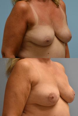 ONCOPLASTIC BREAST REDUCTION
