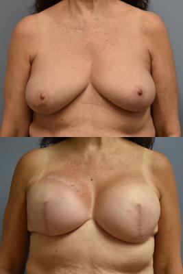 BILATERAL BREAST TISSUE EXPANDER RECONSTRUCTION