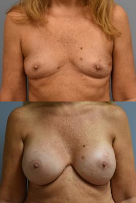 BREAST RECONSTRUCTION WITH TISSUE EXPANDER AND ADM GRAFT