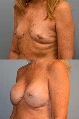 BREAST RECONSTRUCTION TISSUE EXPANDER AND ADM GRAFT