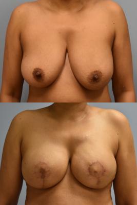 BREAST RECONSTRUCTION WITH TISSUE EXPANDER AND ADN GRAFT