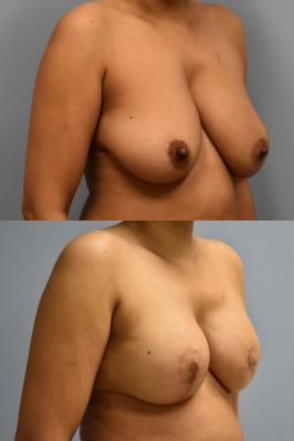 BREAST RECONSTRUCTION WITH TISSUE EXPANDER AND ADM GRAFT