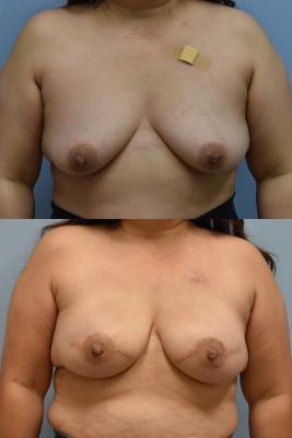 BREAST RECONSTRUCTION WITH TISSUE EXPANDER AND ADM GRAFT