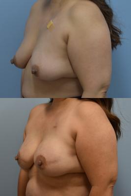 BREAST RECONSTRUCTION WITH TISSUE EXPANDER AND ADM GRAFT