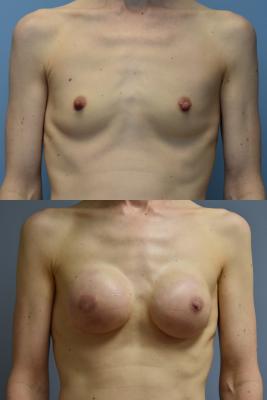 BREAST RECONSTRUCTION WITH TISSUE EXPANDER AND ADM GRAFT
