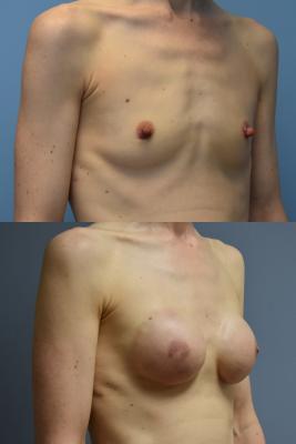 BREAST RECONSTRUCTION WITH TISSUE EXPANDER AND ADM GRAFT