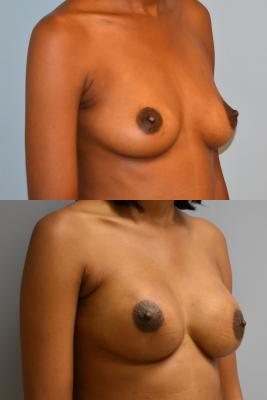 BILATERAL BREAST RECONSTRUCTION WITH TISSUE EXPANDER AND ADM GRAFT