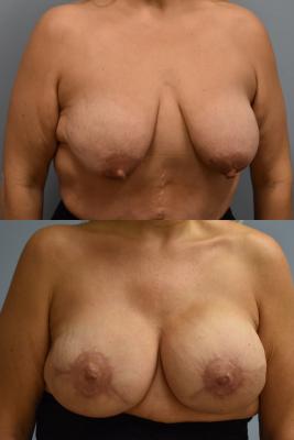 BILATERAL BREAST RECONSTRUCTION WITH TISSUE EXPANDER AND ADM GRAFT