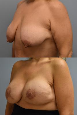 BILATERAL BREAST RECONSTRUCTION AND ADM GRAFT