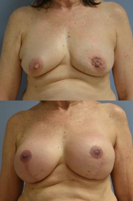 BREAST RECONSTRUCTION WITH TISSUE EXPANDER AND ADM GRAFT
