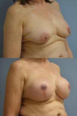 BREAST RECONSTRUCTION WITH TISSUE EXPANDER AND ADM GRAFT
