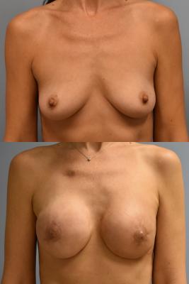BREAST RECONSTRUCTION WITH TISSUE EXPANDER AND ADM GRAFT