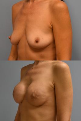 BREAST RECONSTRUCTION WITH TISSUE EXPANDER AND ADM GRAFT