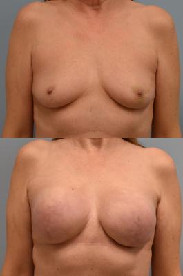 BREAST RECONSTRUCTION WITH TISSUE EXPANDERS 
